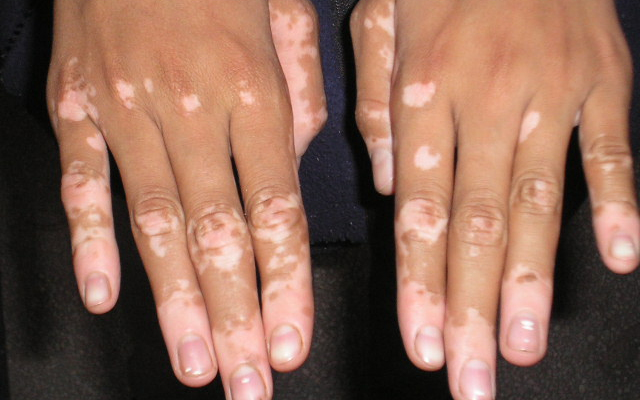 Társbetegségekkel járhat együtt a vitiligo